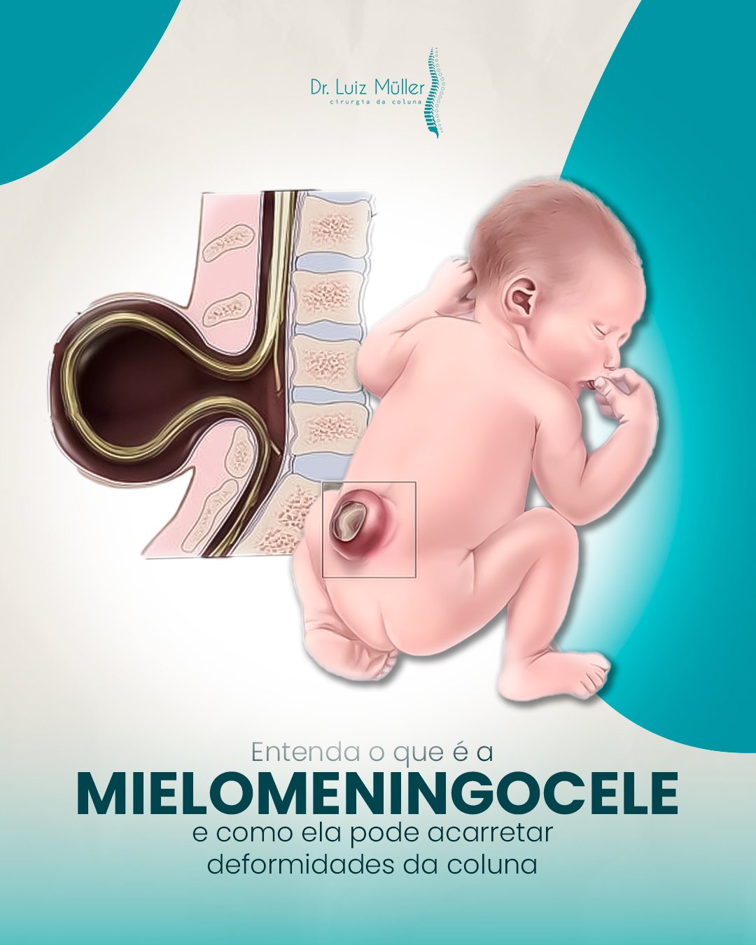 Ilustração de um bebê no útero com a mielomeningocele na coluna, com o texto: entenda o que é a mielomeningocele e como ela pode acarretar deformidades da coluna